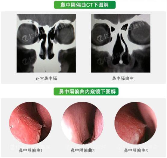 鼻中隔偏曲CT图