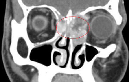 CT显示患者筛窦和鼻腔内布满脓液.jpg
