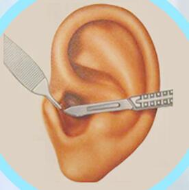 鼓膜-耳屏软骨切膜修补技术优势