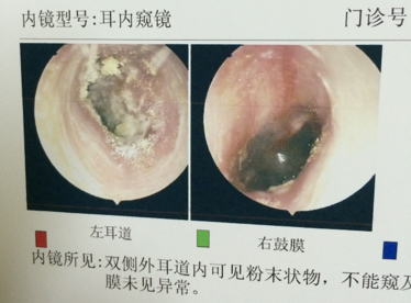 图：外耳道炎的检查报告