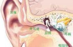 鼓膜穿孔应该怎么治疗